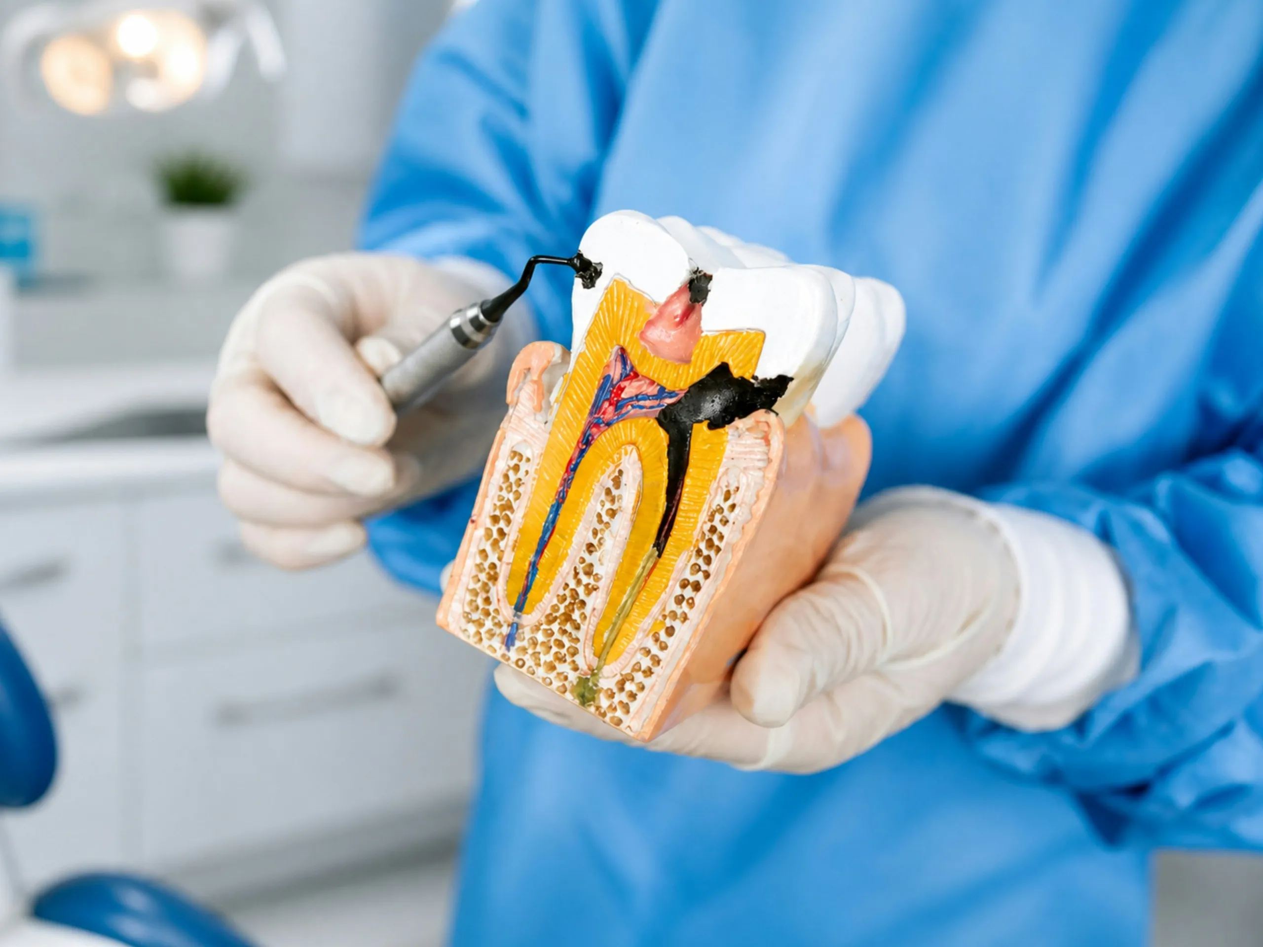 El dentista muestra un modelo en corte de un diente con caries